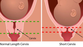 short cervix