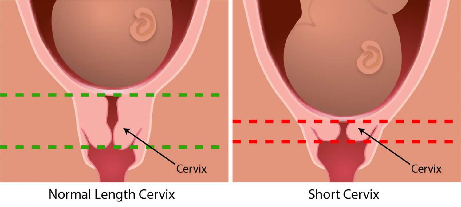 Cervix Incompetent Effaced Short Soft and Low cervix