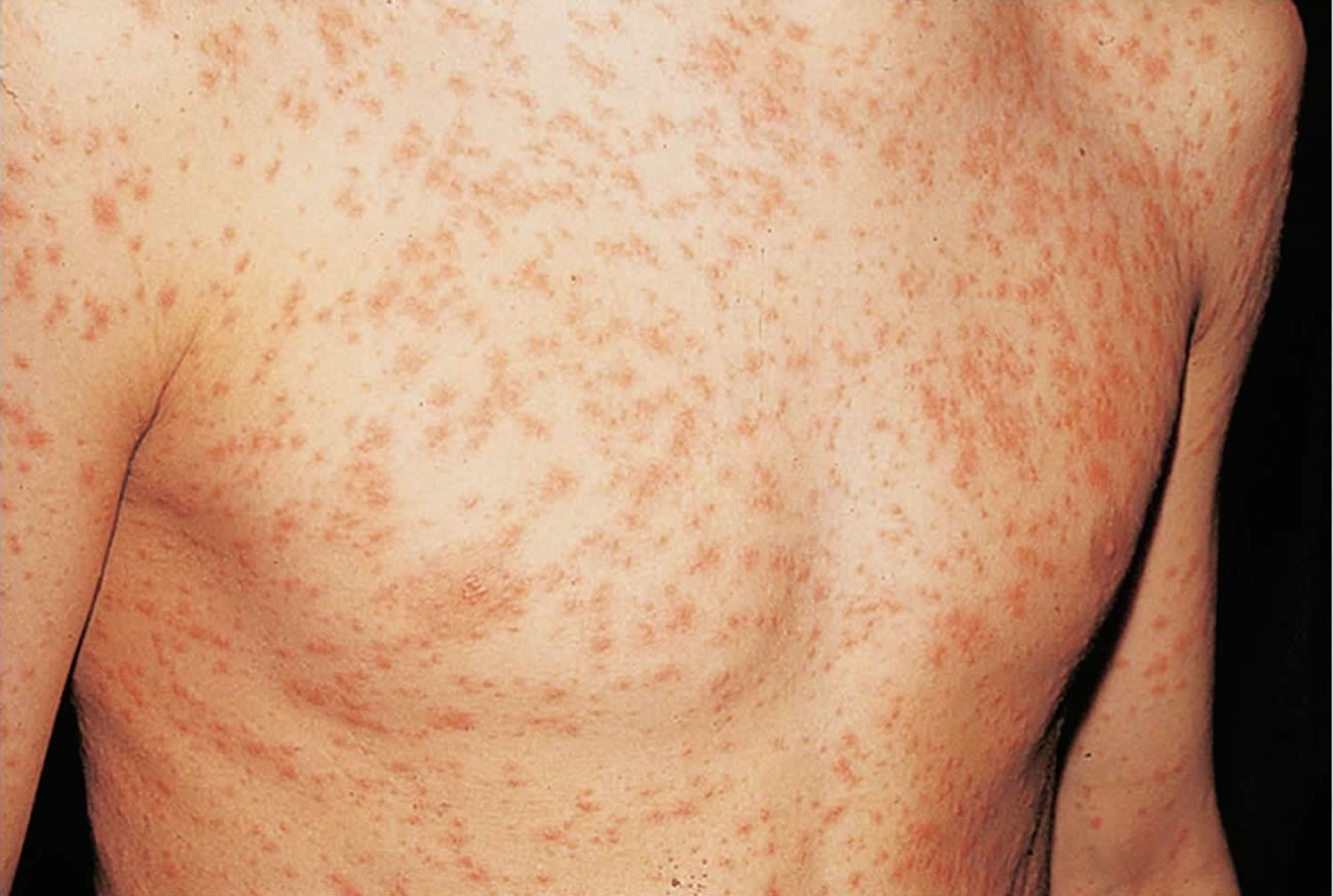 maculopapular rash hiv