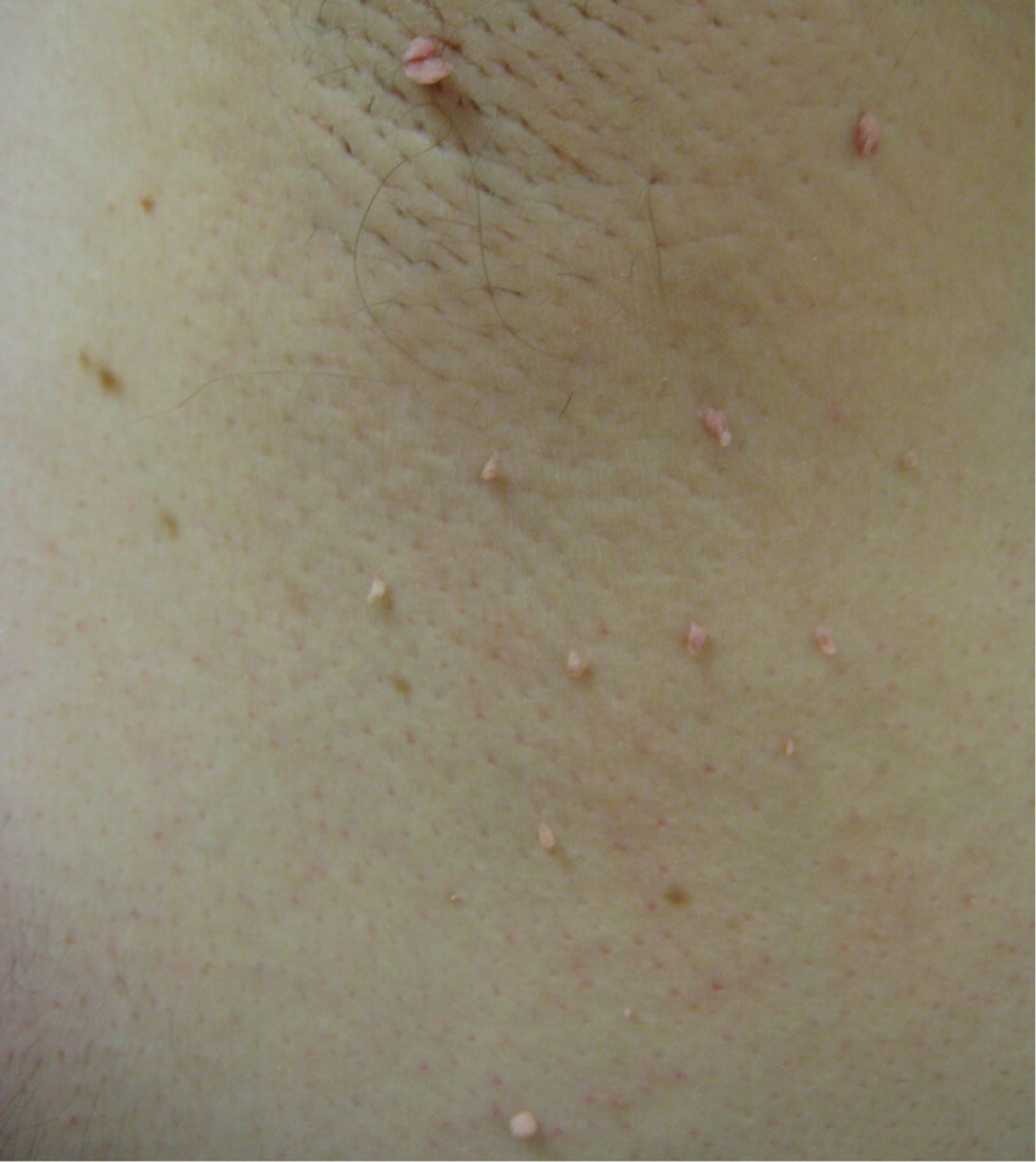 skin tags