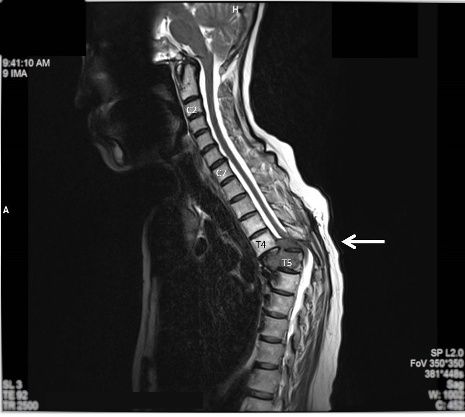 อันดับหนึ่ง 94+ ภาพ ไขสันหลัง spinal cord อัปเดต