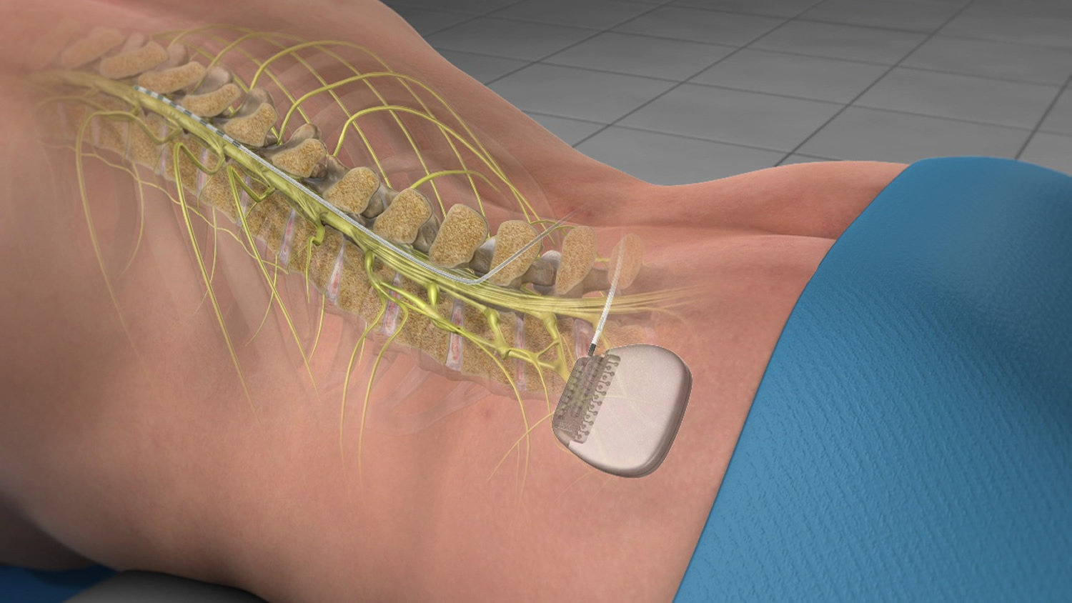 tens placement for dorsal column stimulation