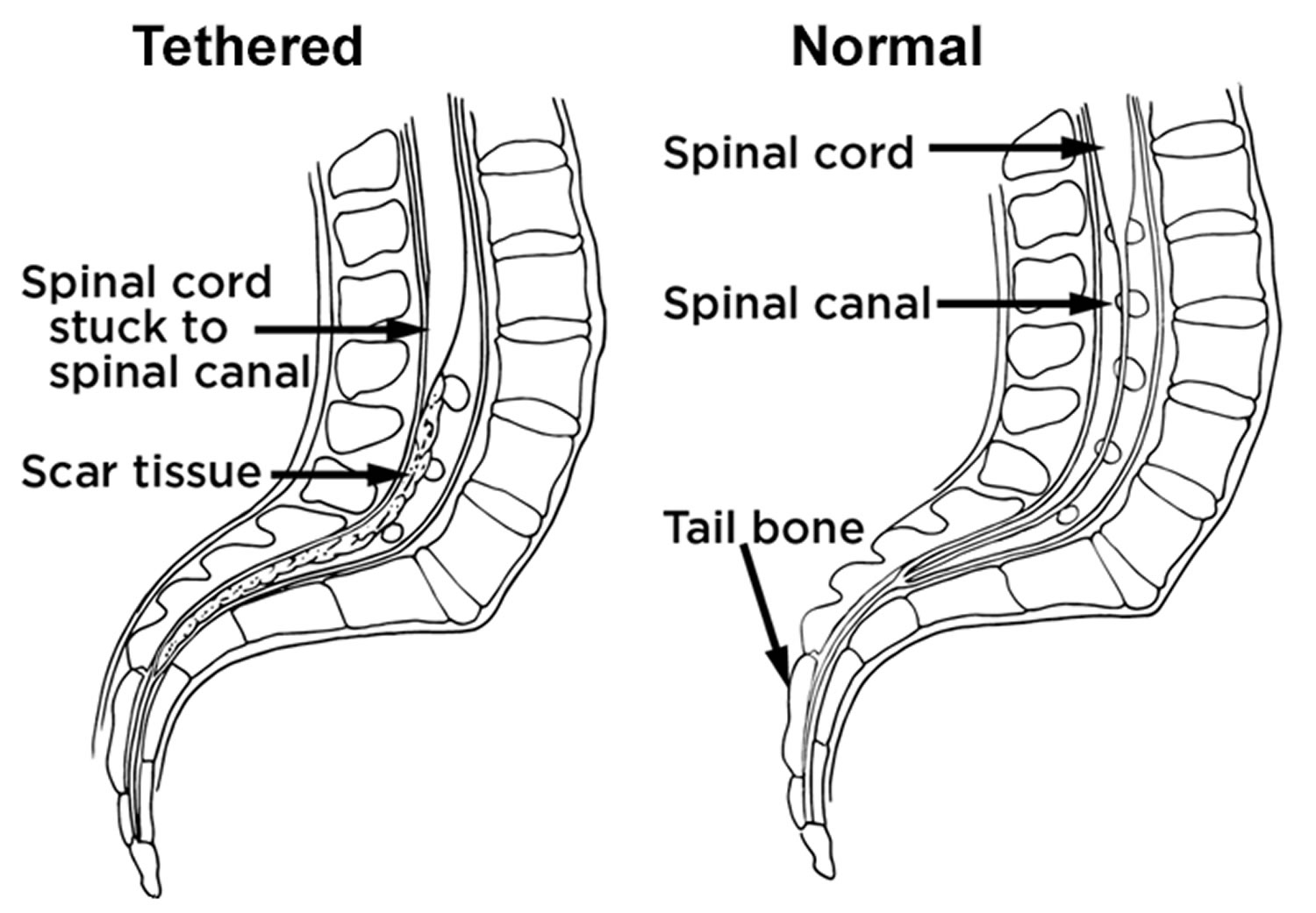 tethered spinal cord