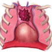 thymus cancer
