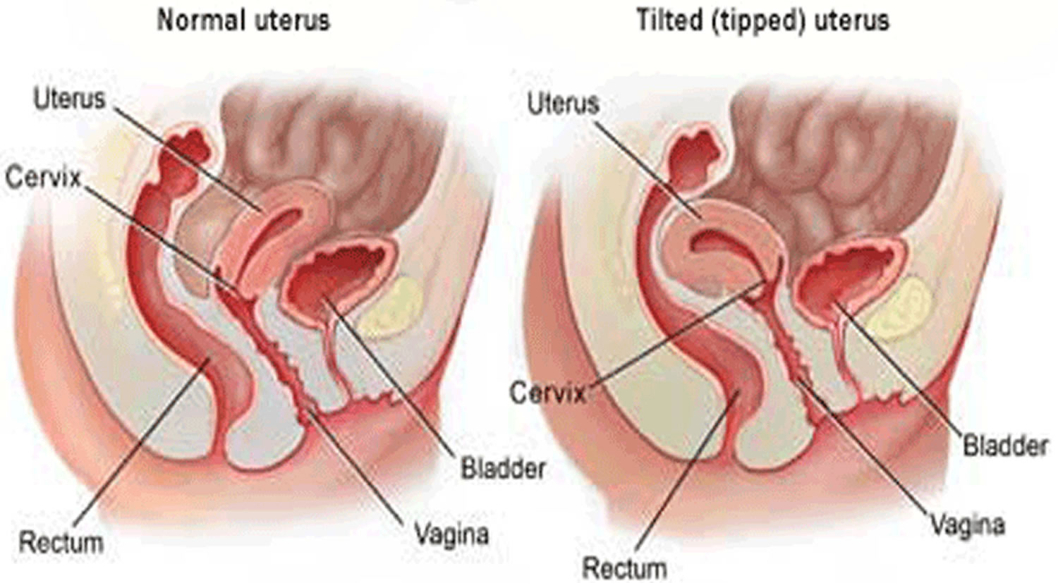 tilted uterus