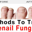 toenail fungus cure