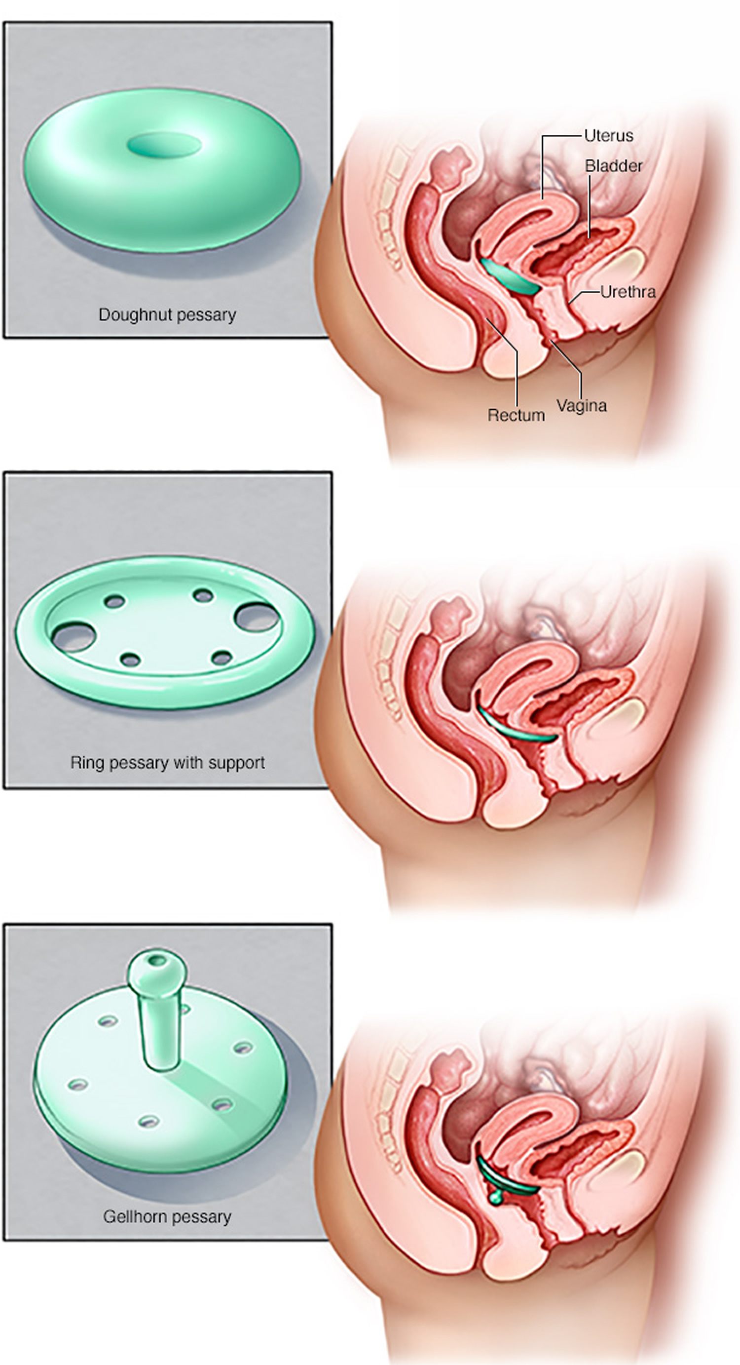 The Causes, Symptoms and Treatment of Uterine Prolapse - Fleur