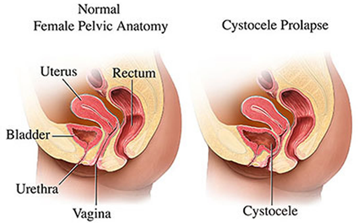 Prolapsed Bladder Causes Symptoms Diagnosis Complication And Treatment 1362