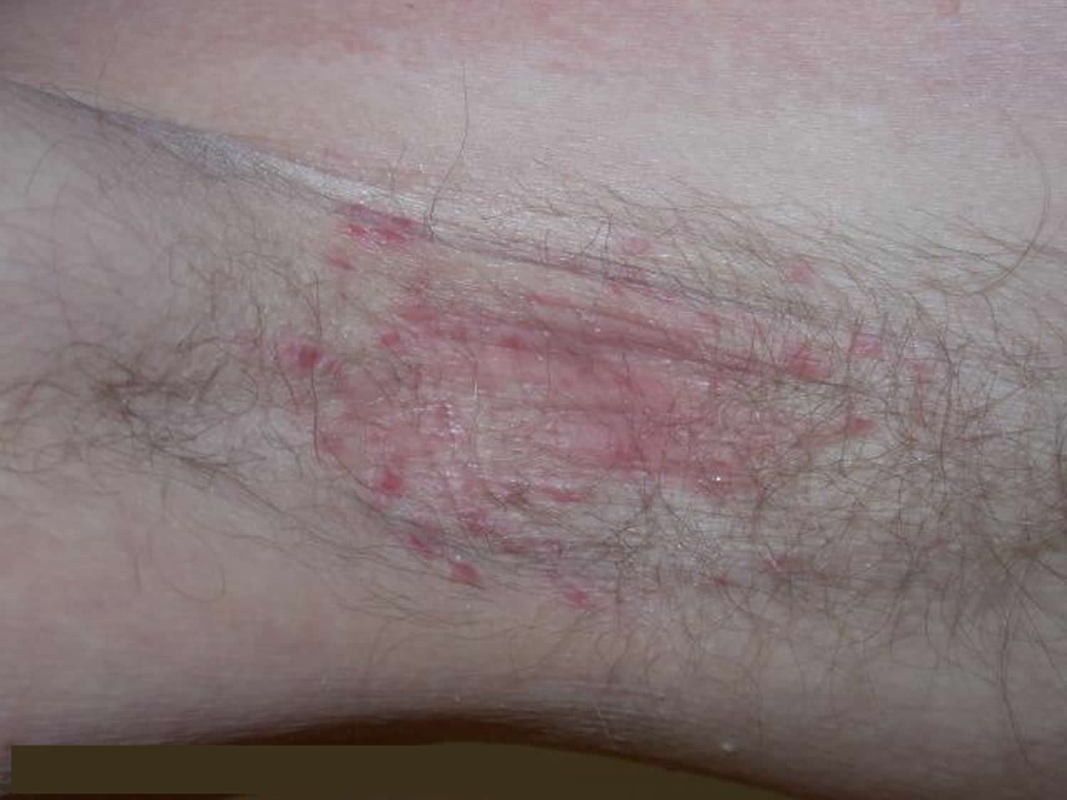 Armpit Seborrhoeic dermatitis