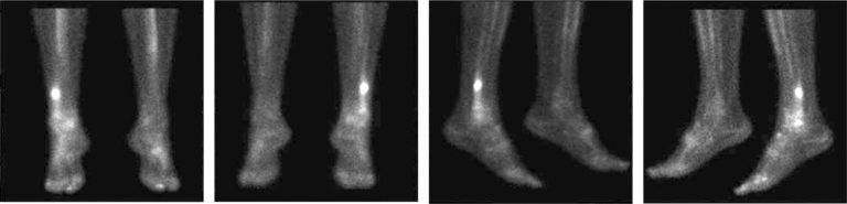 Stress Fracture Foot And Shin Causes Symptoms Prevention And Treatment