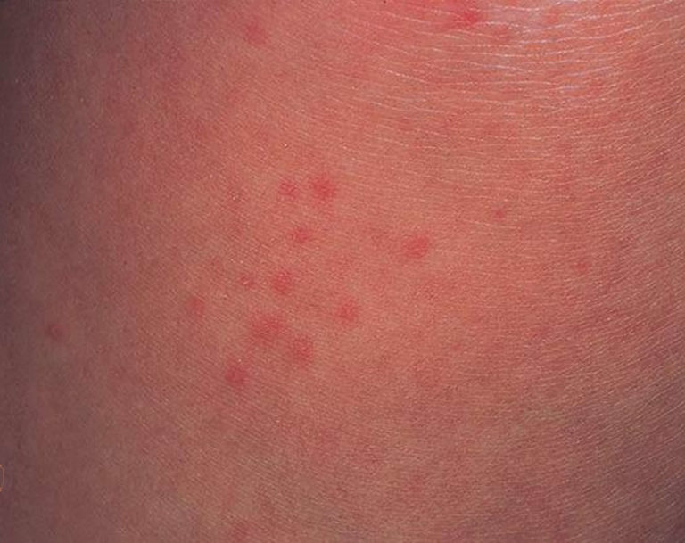 Cholinergic Urticaria - Causes, Diagnosis, Treatment and Prevention