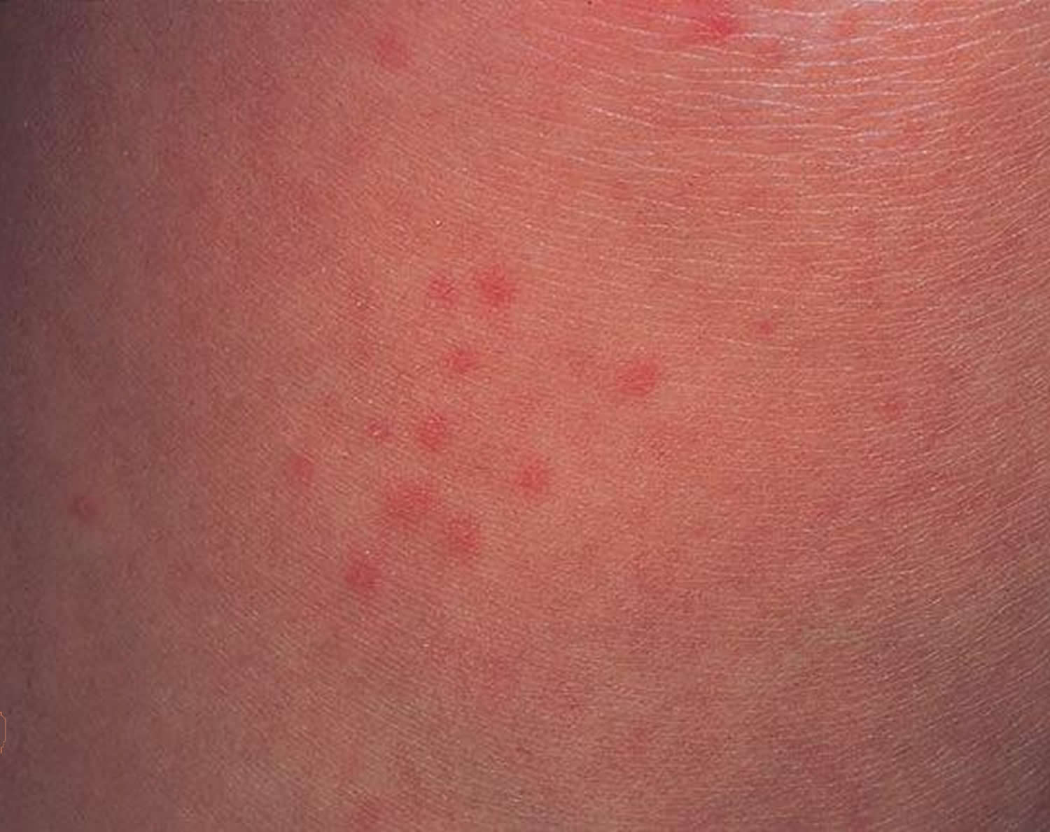 cholinergic urticaria