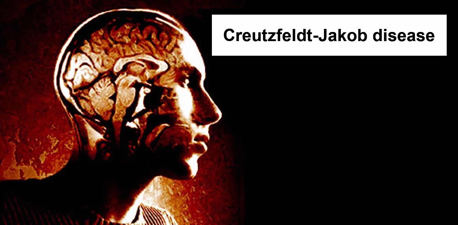 What Is Creutzfeldt Jakob Disease