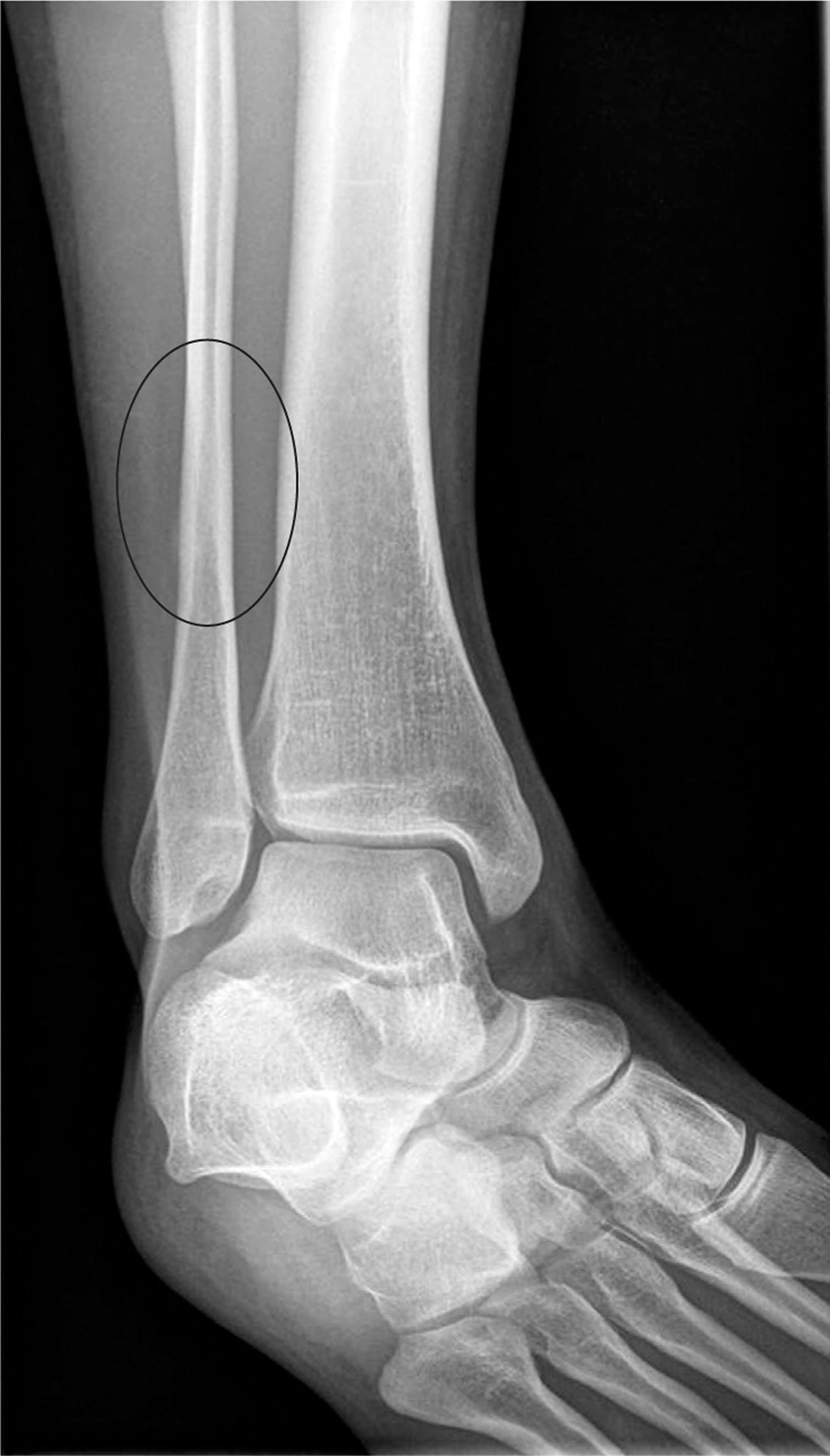 icd 10 code for right distal fibula fracture