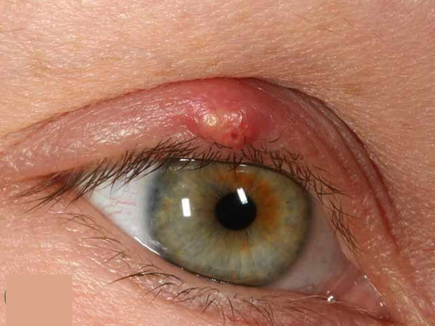 soft bump on eyelid