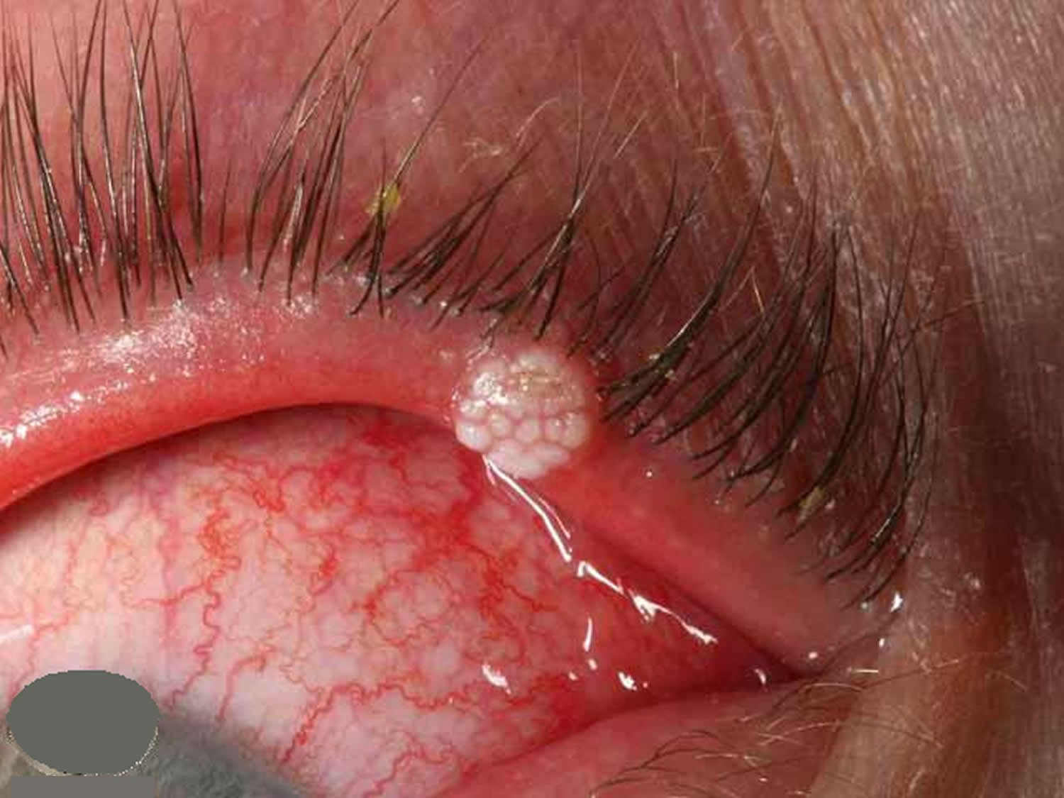 Pimple On Eyelid - Types, Causes & How To Treat Them