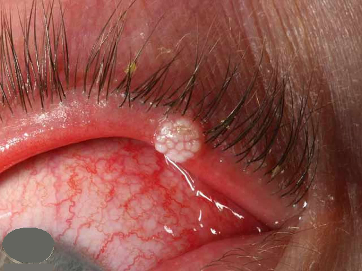 Pimple On Eyelid Types Causes And How To Treat Them