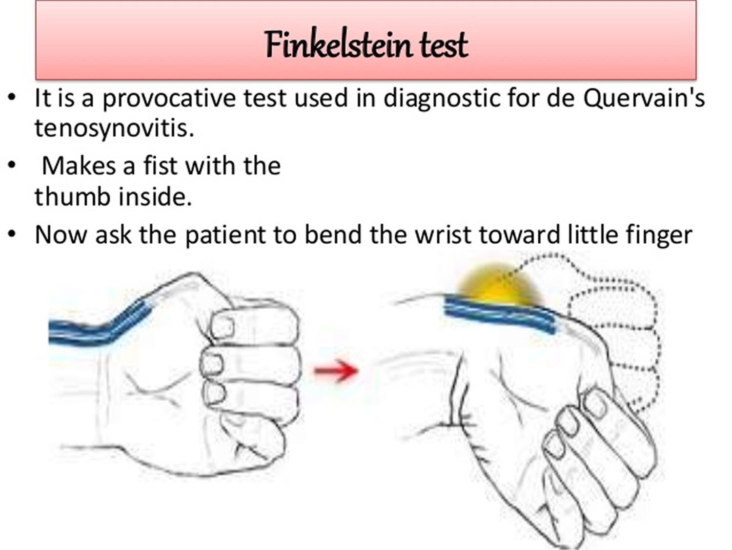 Finkelstein test for wrist tendonitis