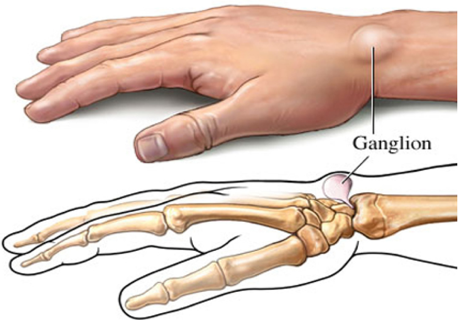 Ganglion Cyst Causes And Management Of Painful Ganglion Cysts