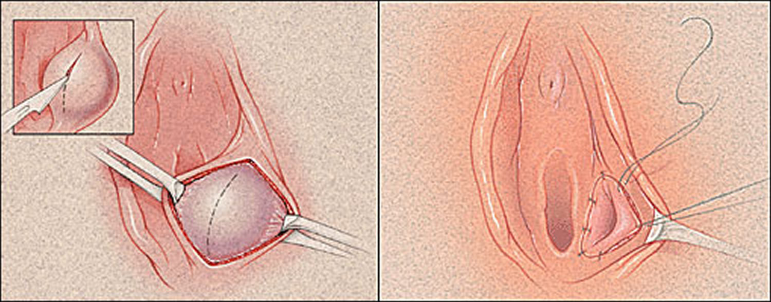 Marsupialization of Bartholins duct cyst