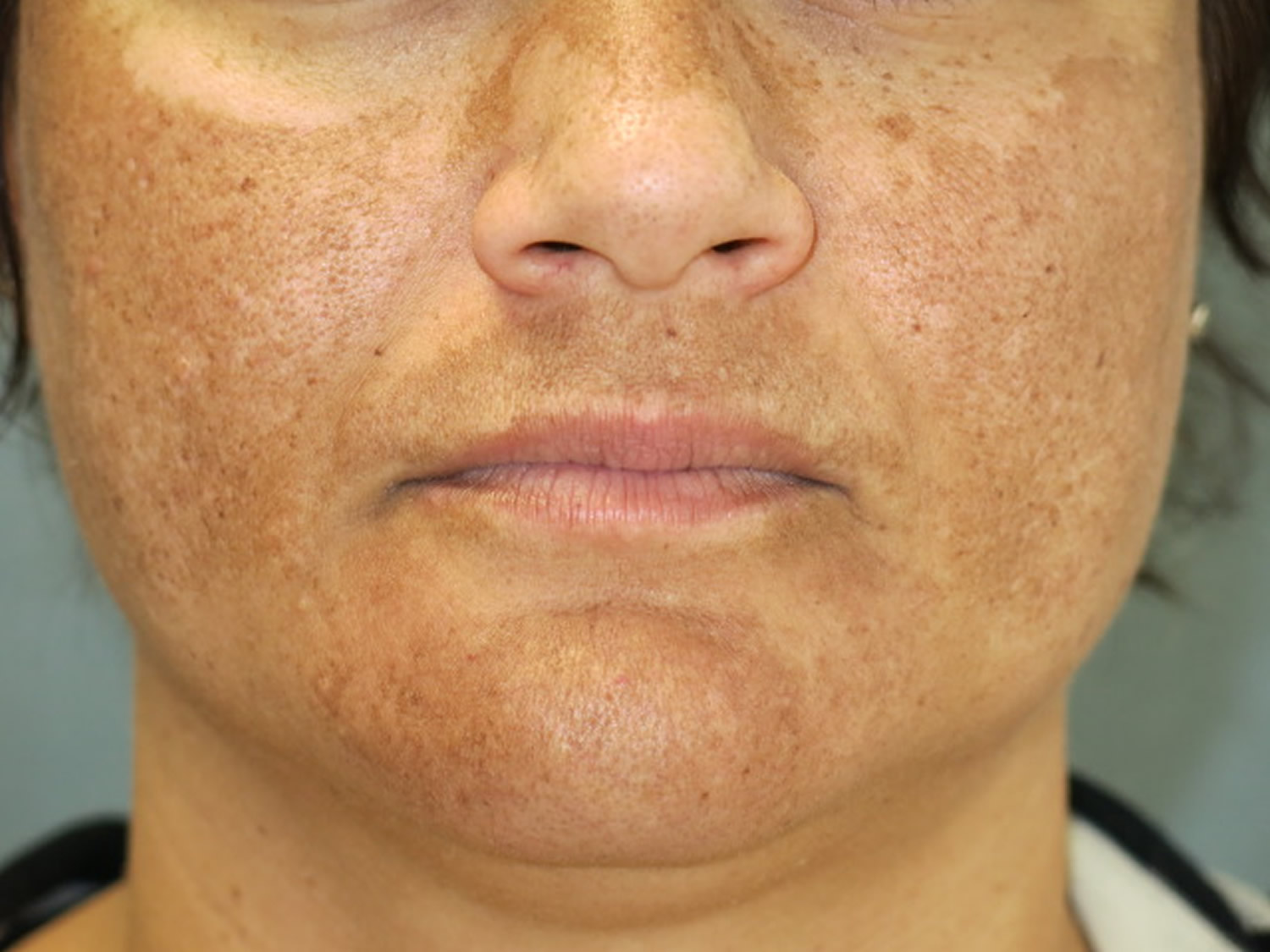 Melasma