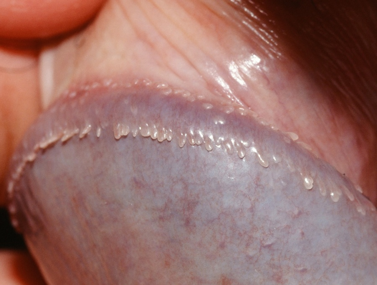 Pearly penile papules are small dome-shaped to thread-like skin-coloured bu...