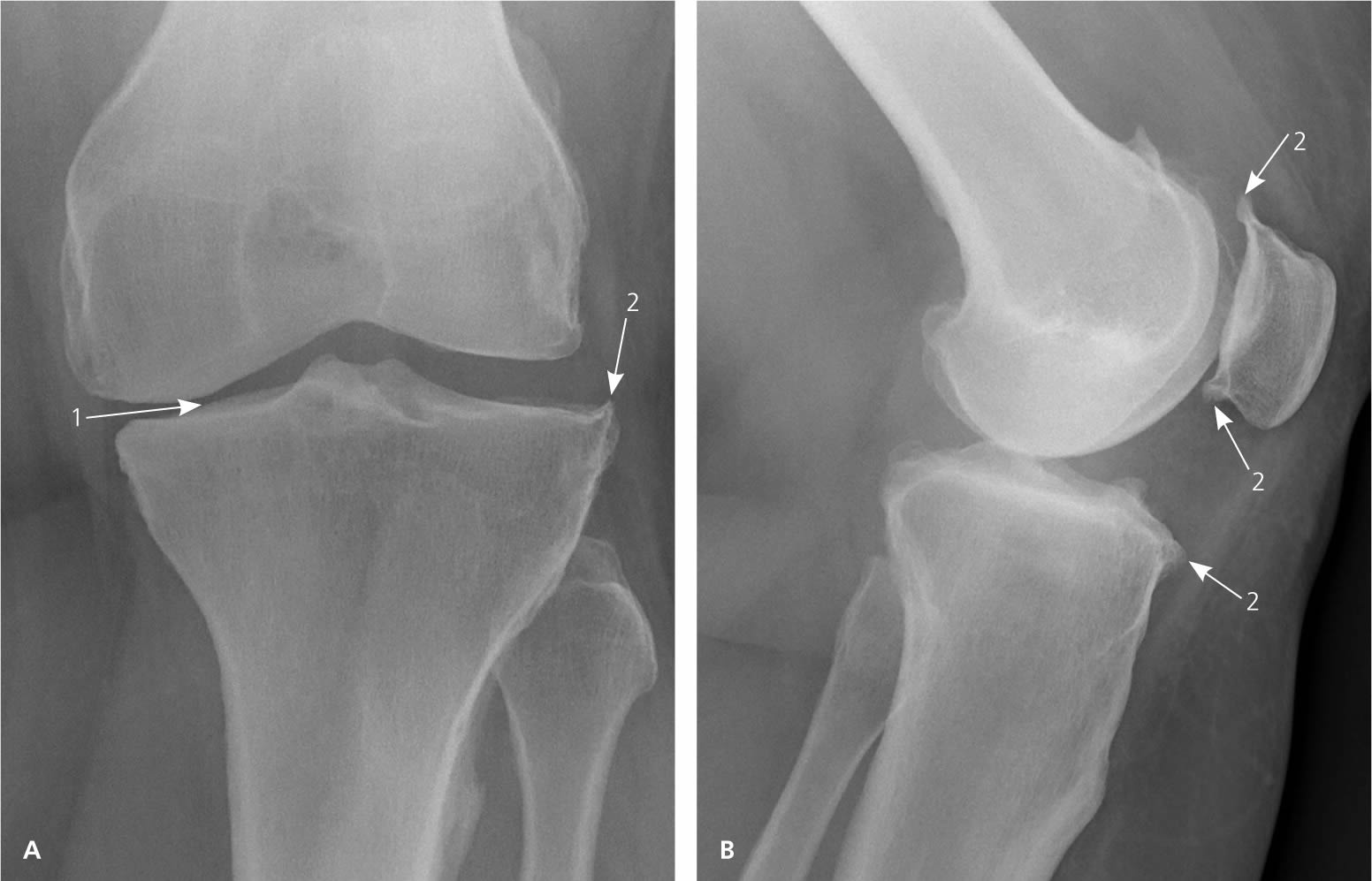 Degenerative Joint Disease Causes Treatment   Radiograph Of Knee Osteoarthritis 