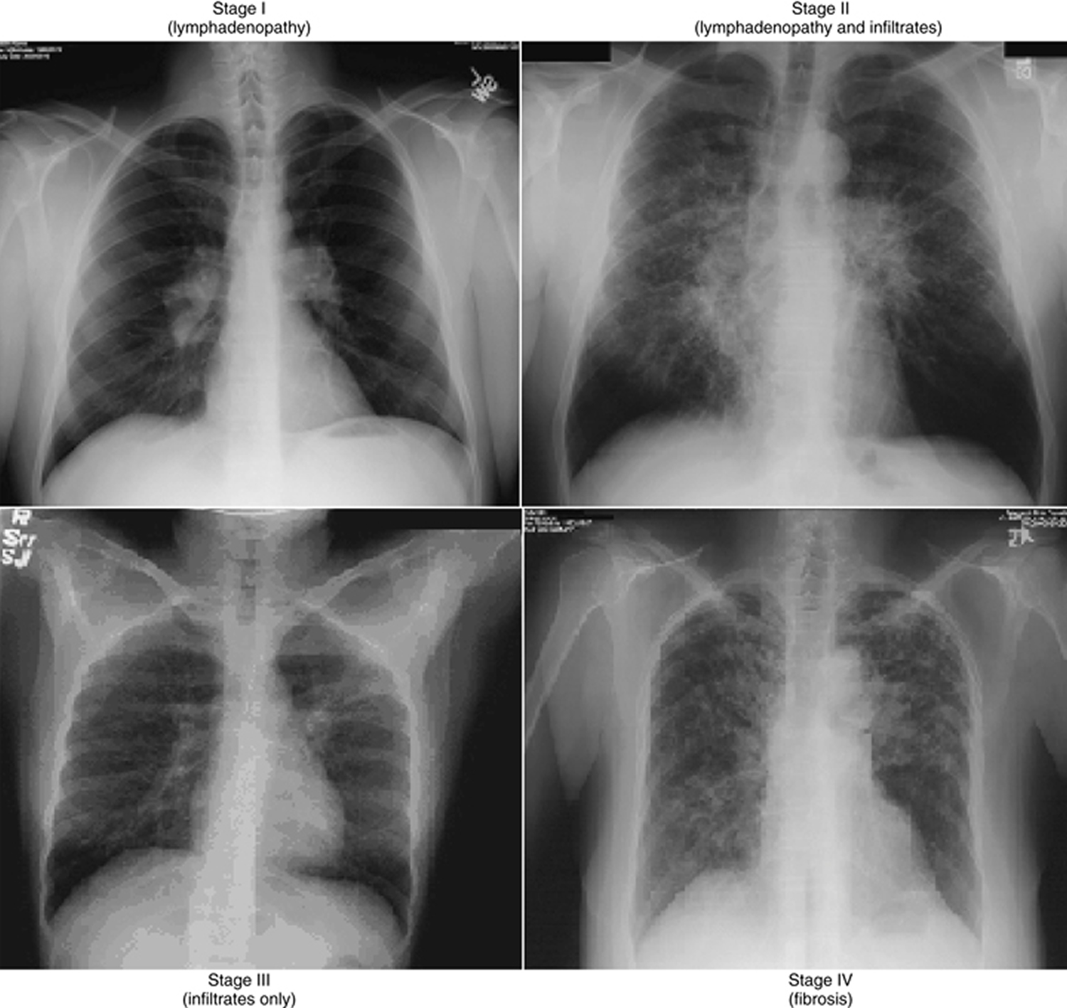 Sarcoidosis-Stages