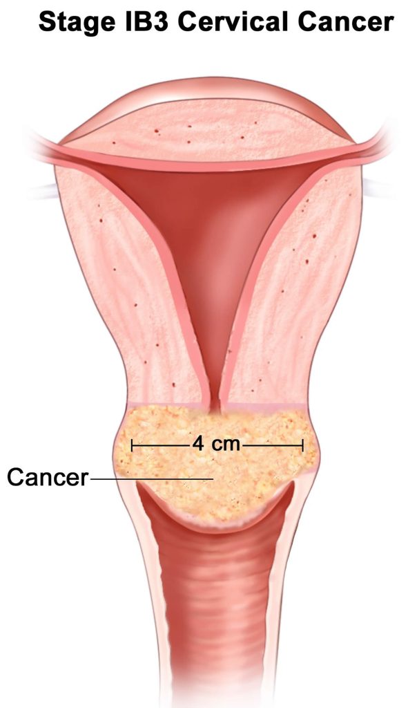 Cervical Cancer Causes Symptoms And Signs Treatment 6086