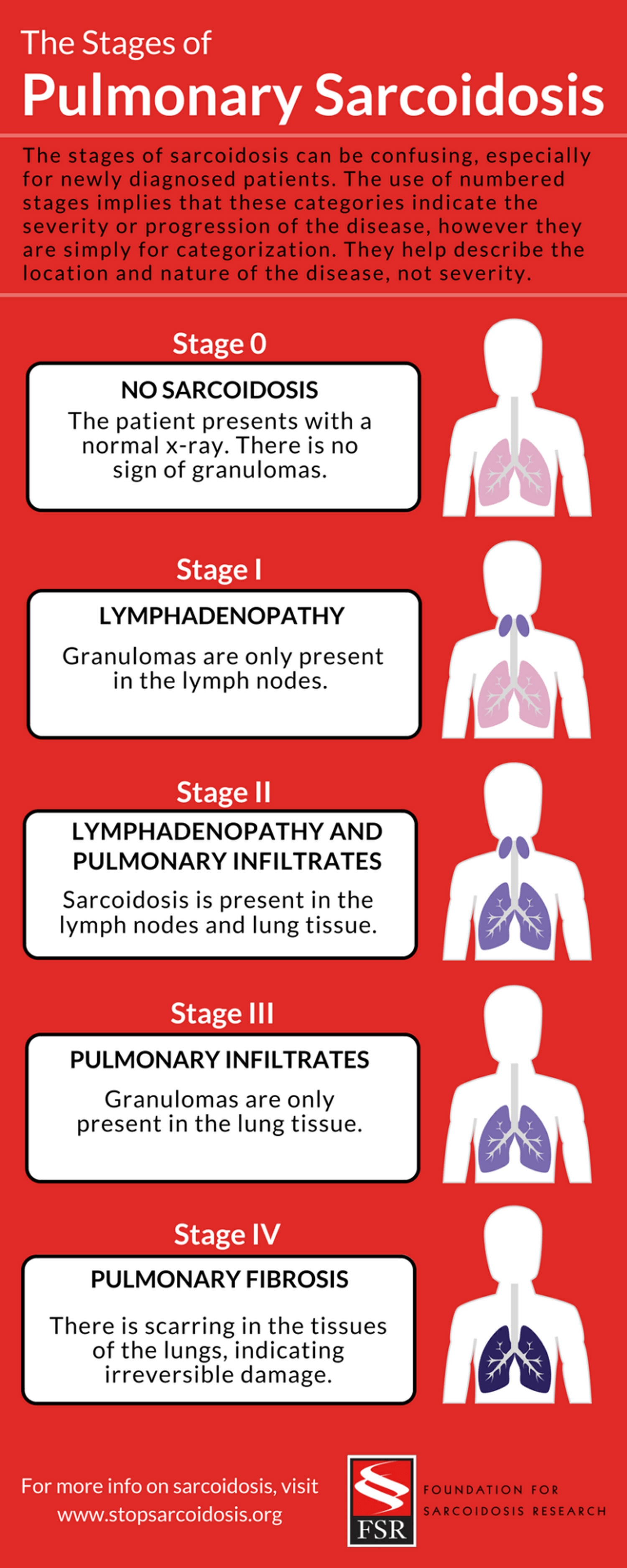 Stages-of-Pulmonary-Sarcoidosis