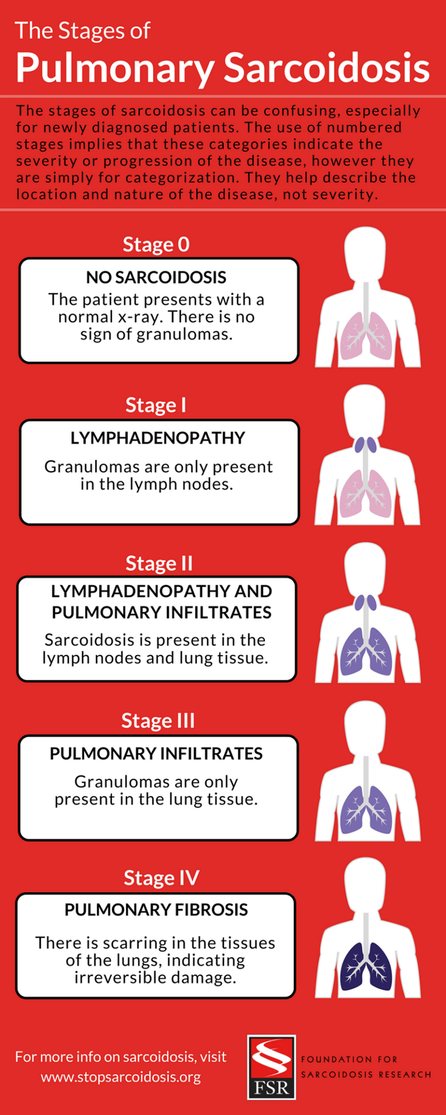 prognosis for stage 4 mesothelioma