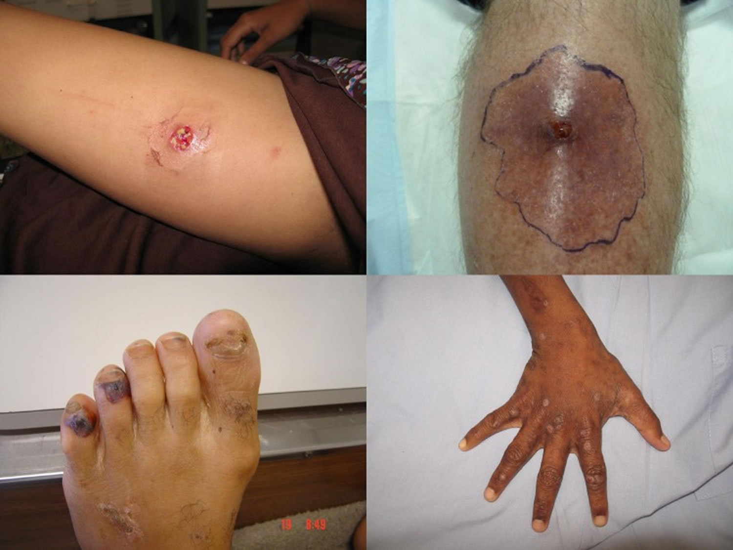 Staph skin and soft tissue infections