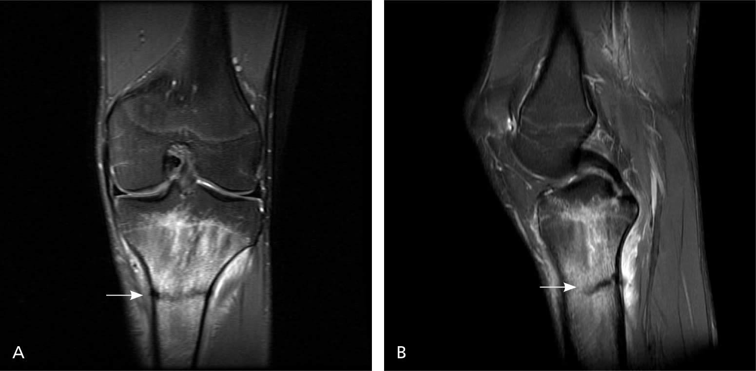 running on stress fracture shin