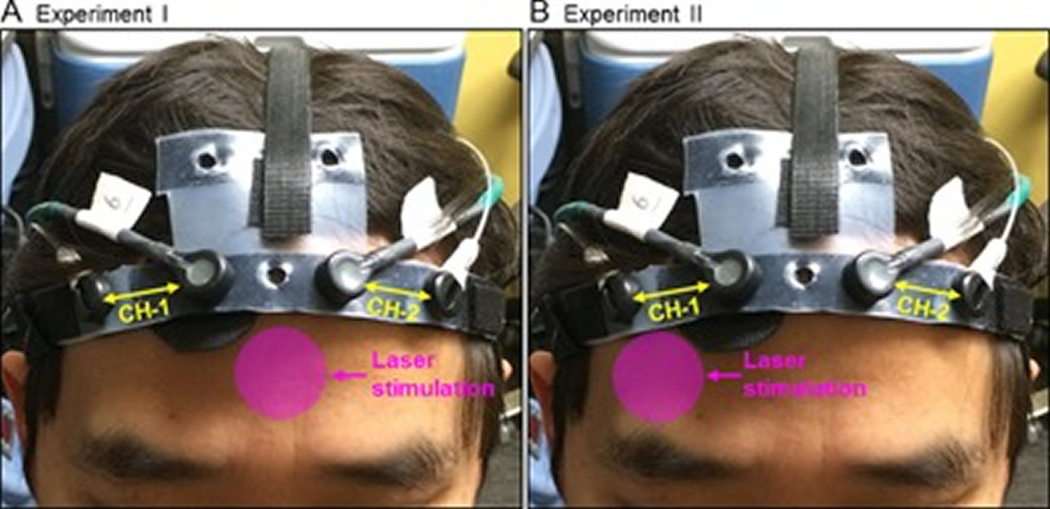 Transcranial photobiomodulation