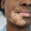 Vitiligo
