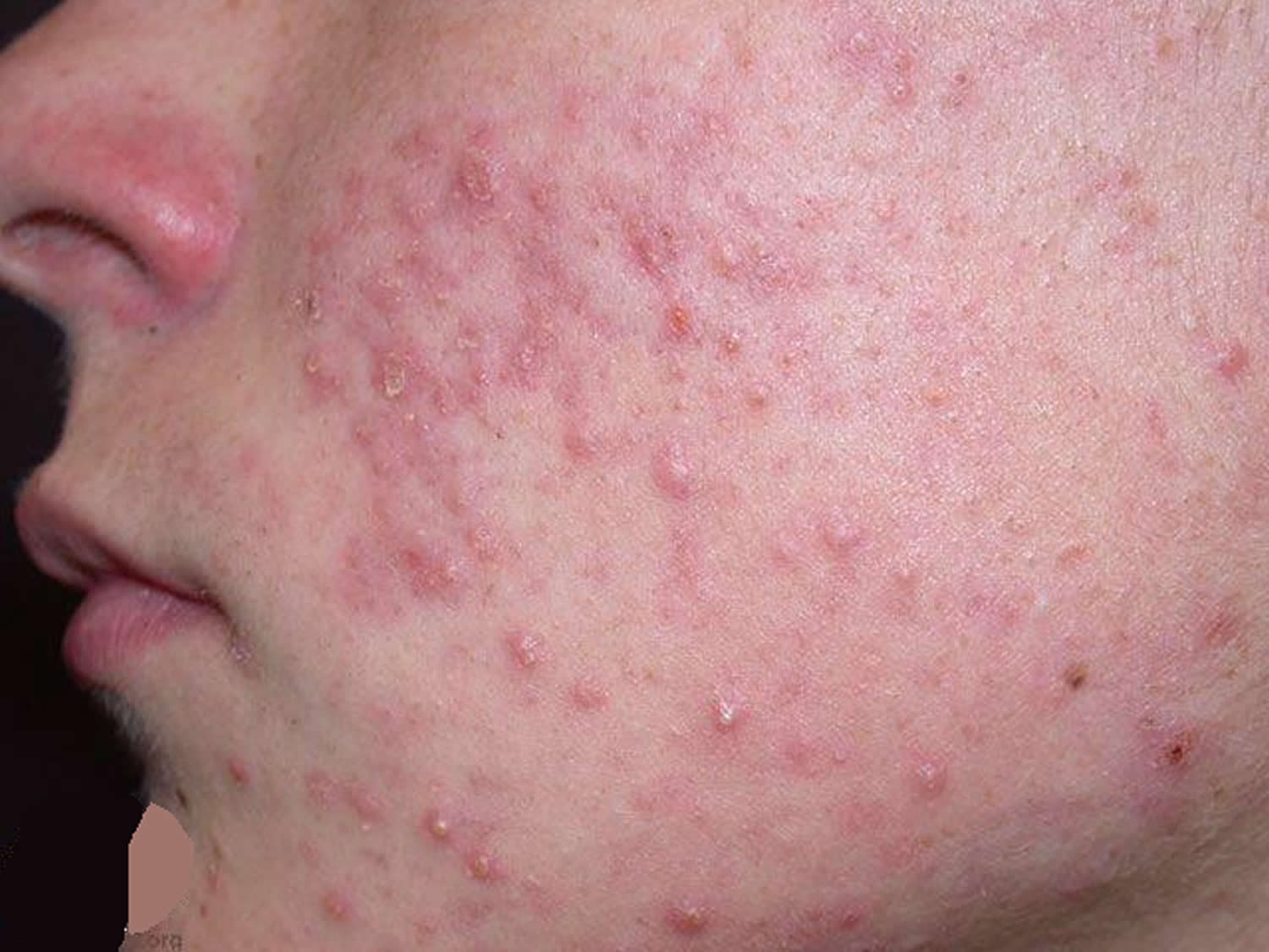 Acne Pimples Caises Best Treatment To Get Rid Of Acne And Pimples