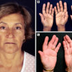 addison’s disease