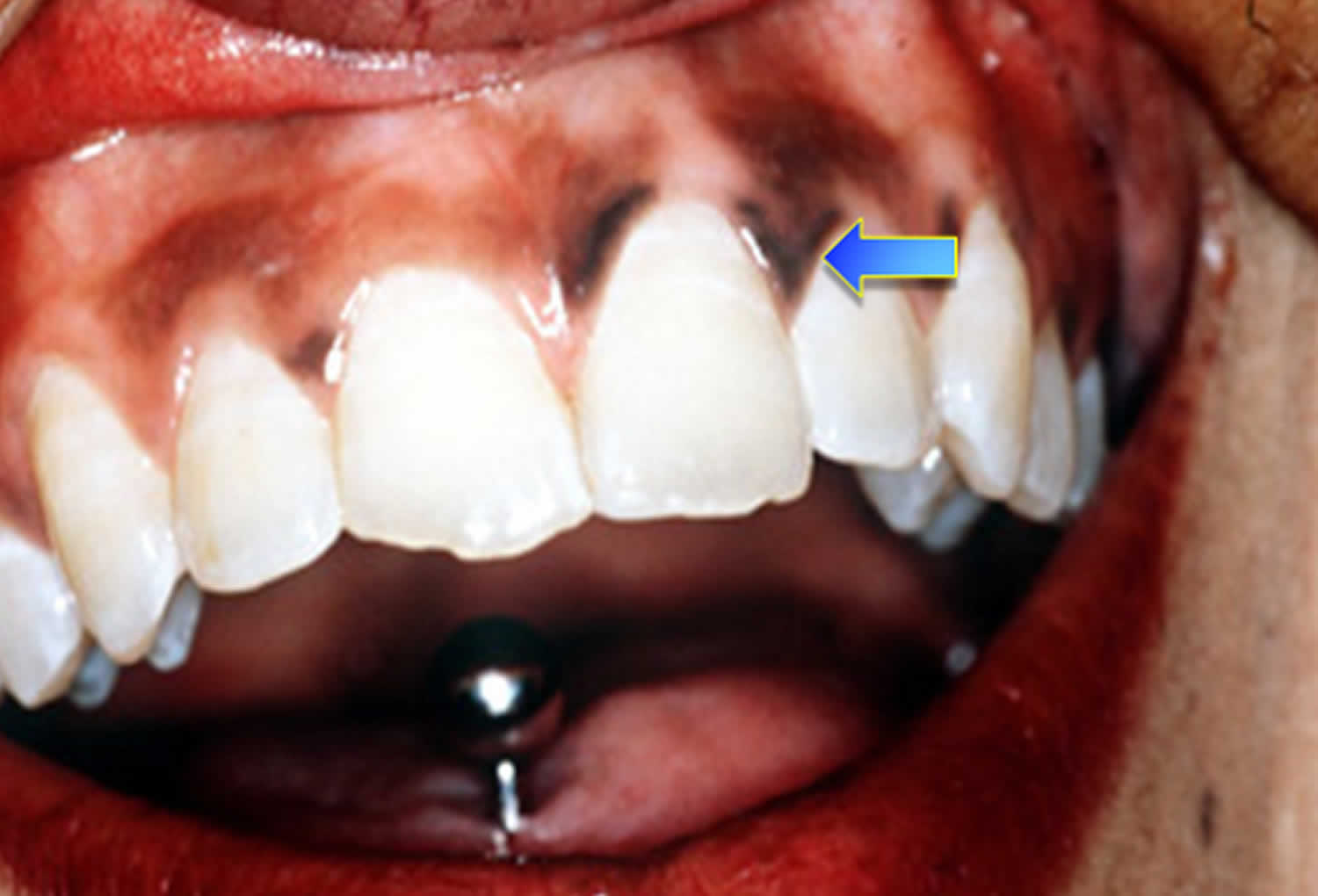 addisons disease hyperpigmentation