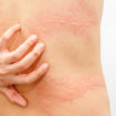 aquagenic urticaria