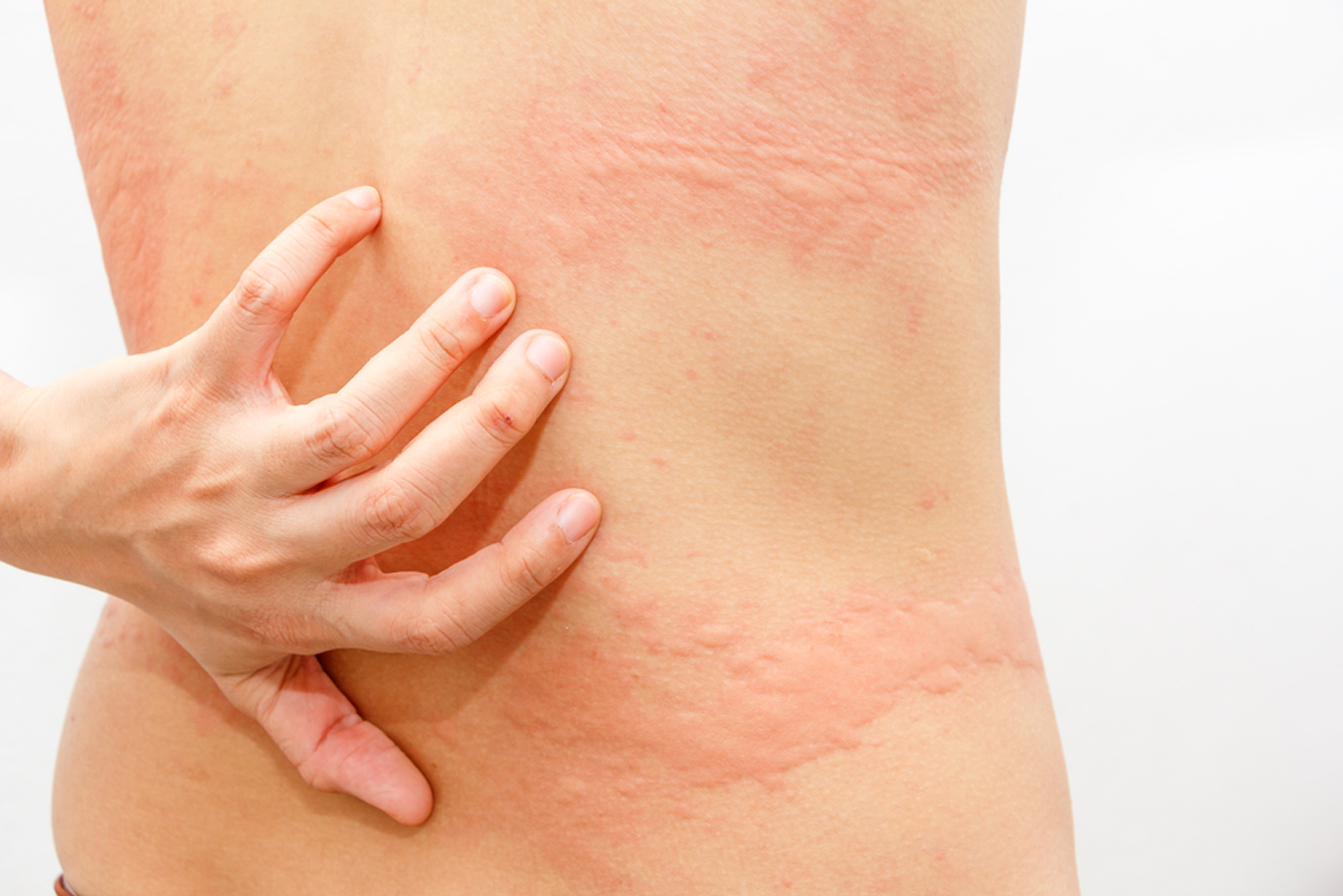 Aquagenic Urticaria Causes Diagnosis Facts And Treatment