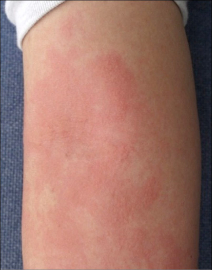 Aquagenic Urticaria - Causes, Diagnosis, Facts and Treatment