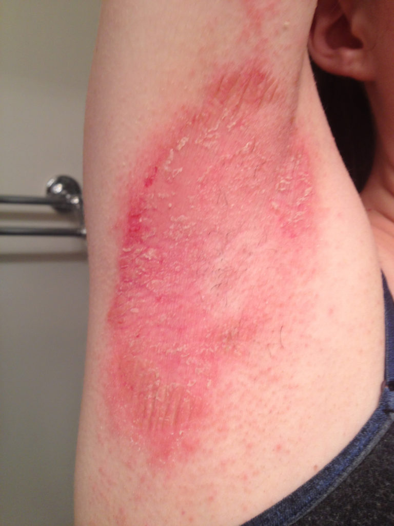 Armpit Rash Itchy Candida Causes And Treatment 