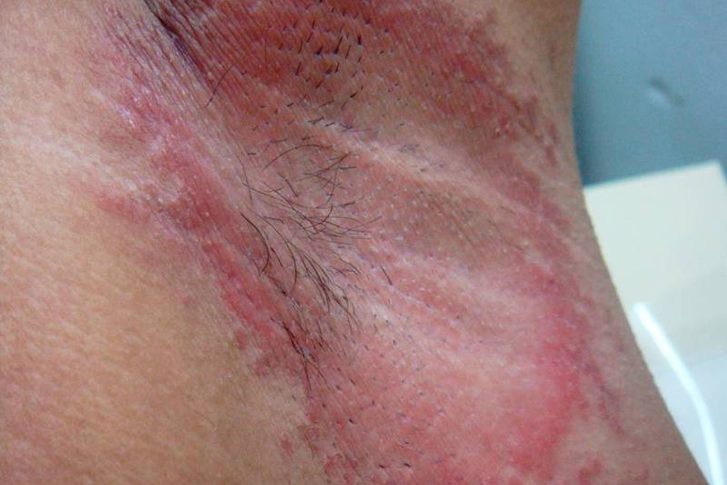 pictures of swimmers itch rash