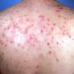 back acne