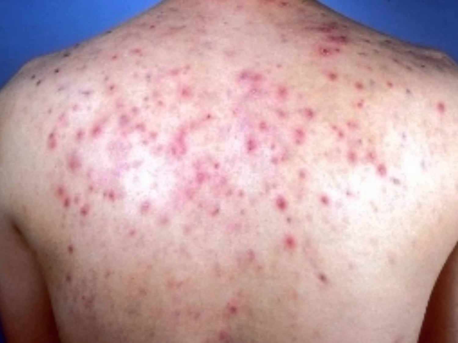 Back Acne Causes and Best Treatment to Get Rid of Back ...