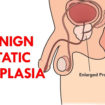 benign prostatic hyperplasia