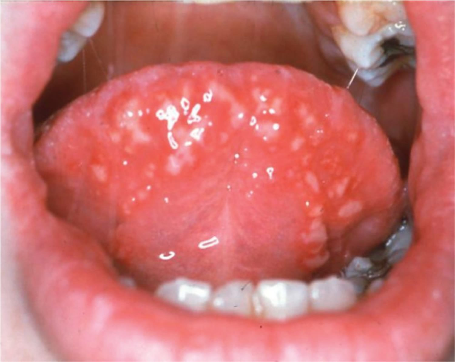 Tongue blister under small clear Causes of