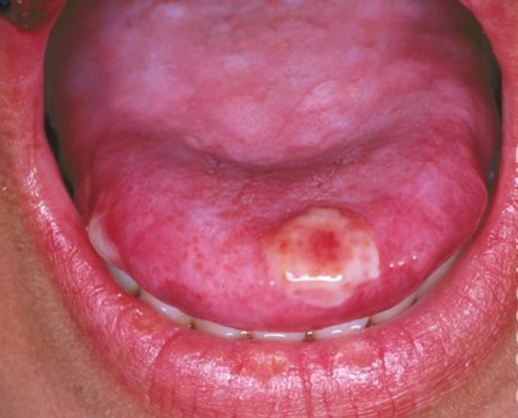 blisters-on-tongue-blisters-under-or-side-of-tongue-causes-treatment