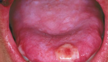 blisters on tongue