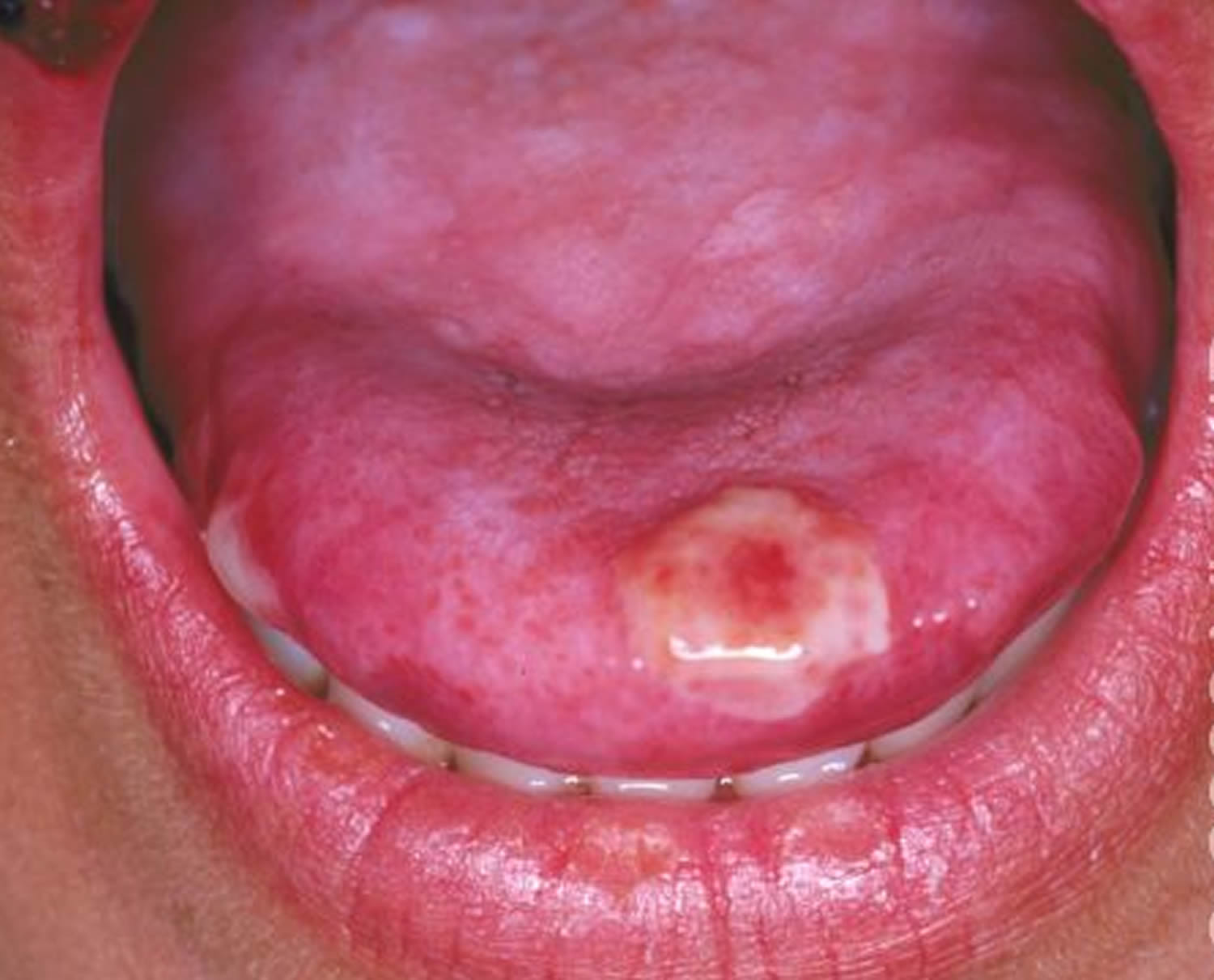 blisters on tongue